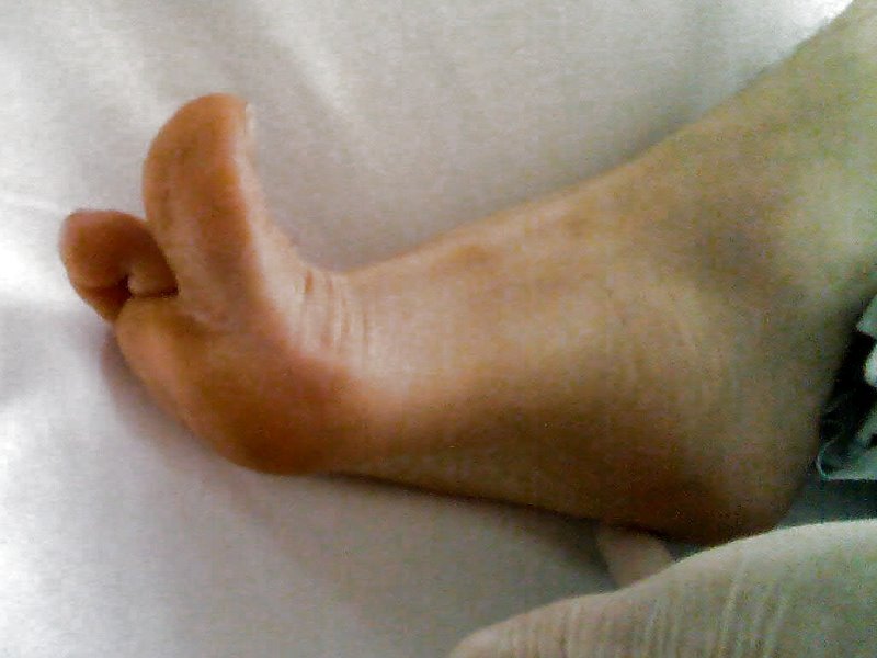 “BabinskiSign.jpg” by Medicus of Borg is in the Public Domain Photo showing closeup of an adult's splayed toes