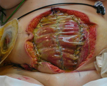 “Bogota bag.png” by Suarez-Grau JM, Guadalajara Jurado JF, Gómez Menchero J, Bellido Luque JA is licensed under CC BY 4.0 Photo showing dehiscence on abdominal wound