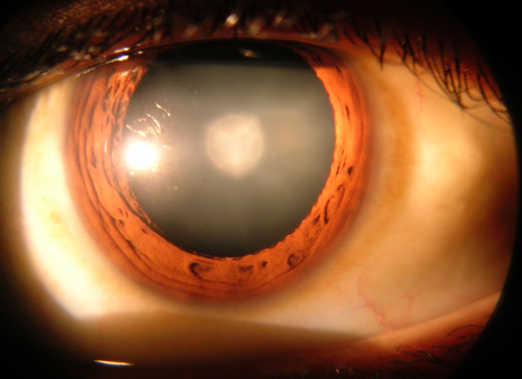 “Cataract in human eye.png” by Rakesh Ajuja, MD is licensed under CC BY-SA 3.0 Photo showing closeup of eye with cataract