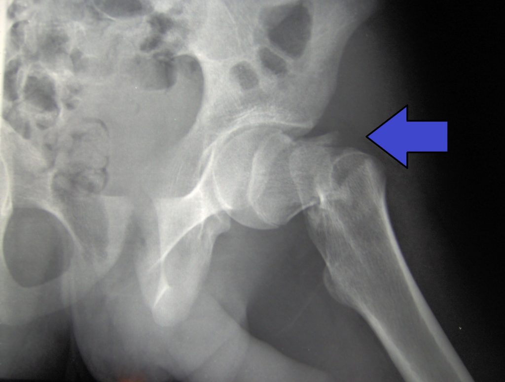 “Cdm hip fracture 343.jpg” by Booyabazooka is licensed under CC BY-SA 3.0 Xray image showing an arrow pointing at hip fracture
