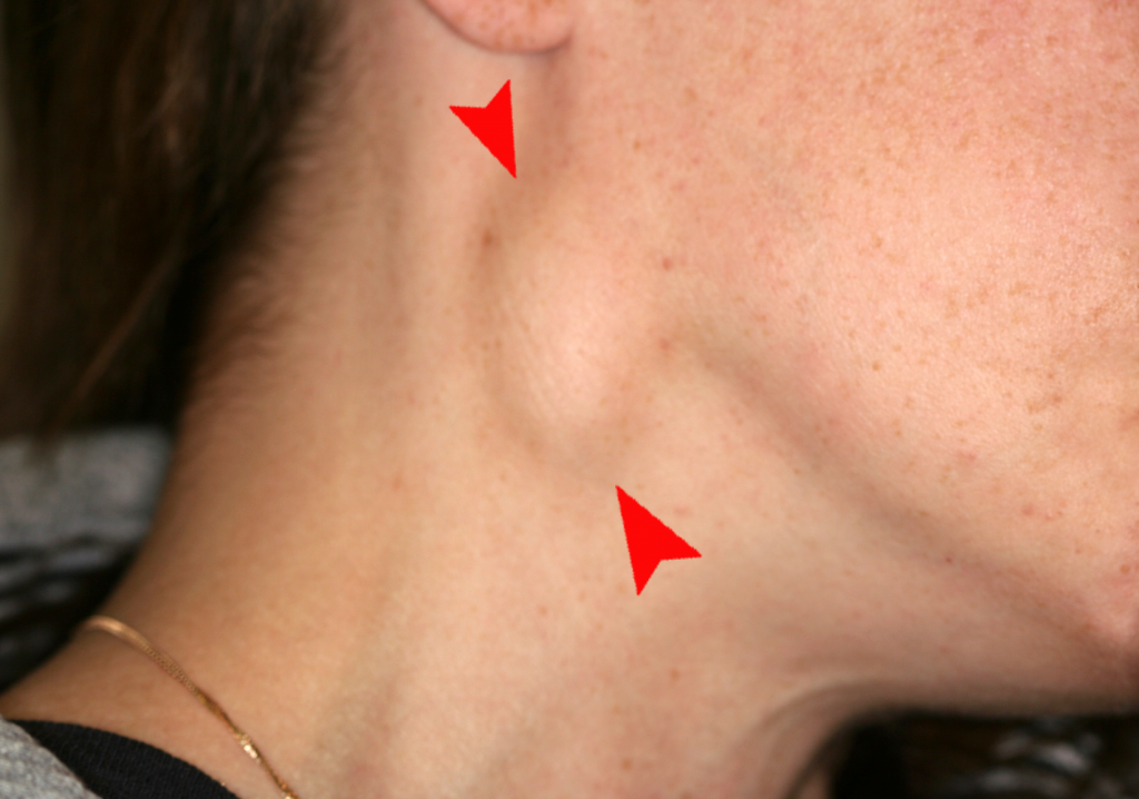 “Cervical lymphadenopathy right neck.png” by Coronation Dental Specialty Group is licensed under CC BY-SA 4.0 Photo of enlarged lymph node on a person's neck, with arrows to help identify swollen spot