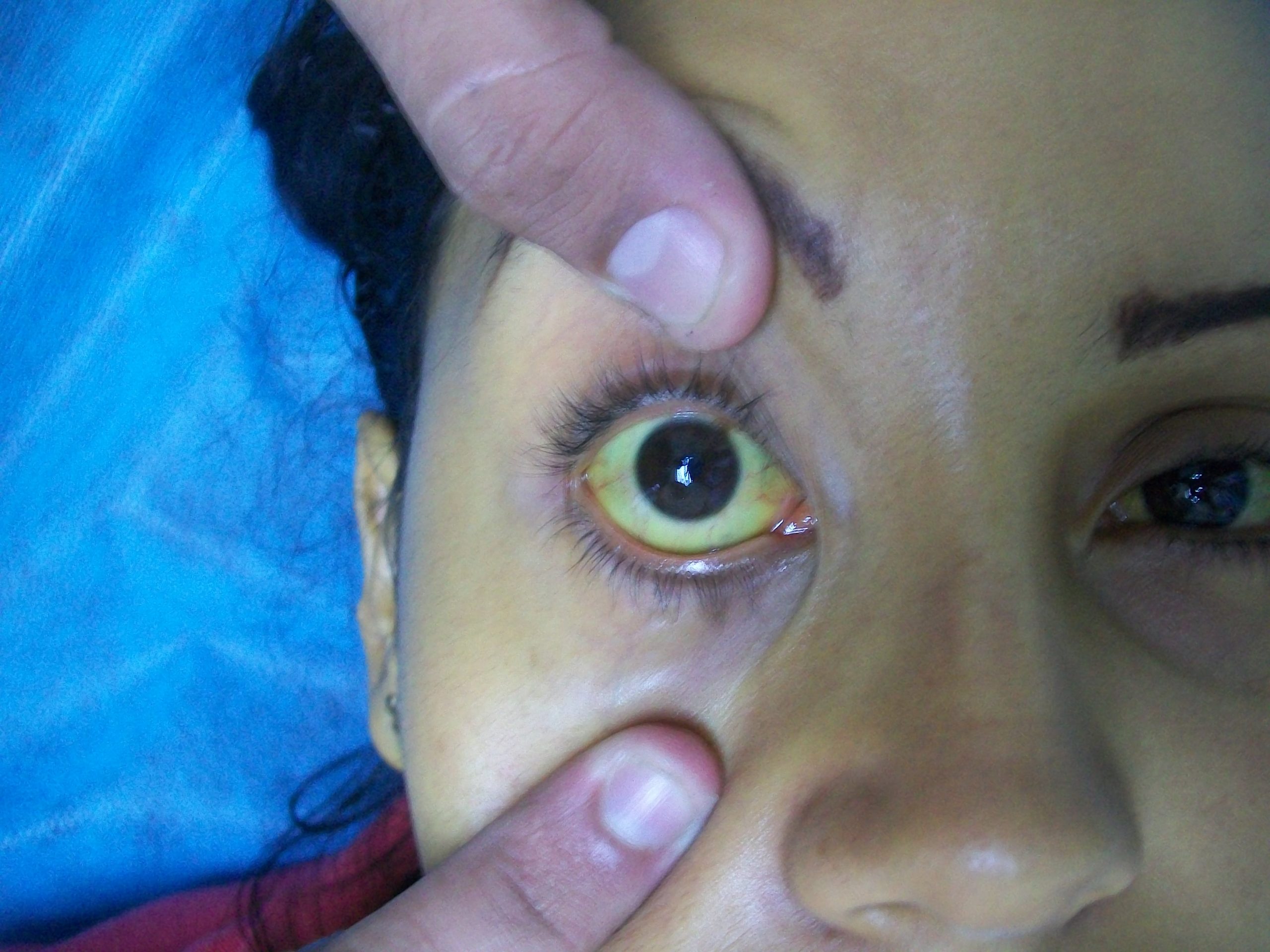 “Cholangitis Jaundice.jpg” by Bobjgalindo is licensed under CC BY-SA 4.0 Photo showing yellowed sclera of eye due to jaundice