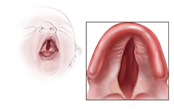 “Cleft palate.jpg” by Centers for Disease Control and Prevention (CDC) is licensed under CC0 1.0 Illustration showing cleft palate in an infant