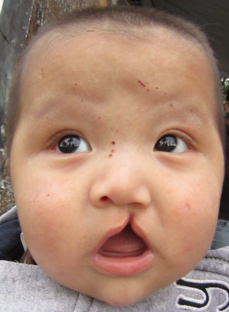 “Cleftlipandpalate.JPG” by James Heilman, MD is licensed under CC BY-SA 3.0 Photo showing young child with cleft lip