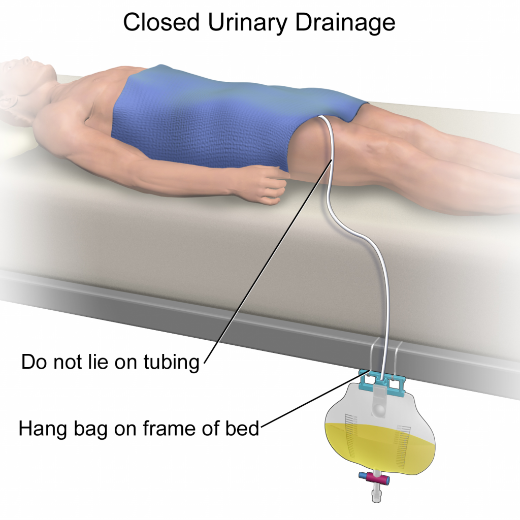 ”Closed Urinary Drainage.png” by BruceBlaus is licensed under CC BY-SA 4.0 Illustration showing placement of urine collection bag, with labels
