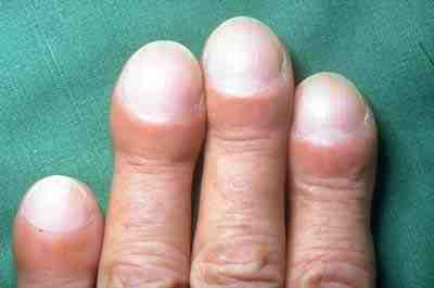 “Clubbing of fingers in IPF.jpg” by IPFeditor is licensed under CC BY-SA 3.0 Photo showing clubbing of fingertips