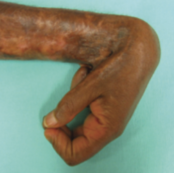 “Complications of Hypertrophic Scarring.png” by Aarabi S, Longaker MT, Gurtner GC (2007) Hypertrophic Scar Formation Following Burns and Trauma: New Approaches to Treatment. PLoS Med 4(9): e234. doi:10.1371/journal.pmed.0040234 is licensed under CC BY 3.0 Photo of contracture on a person's wrist and hand
