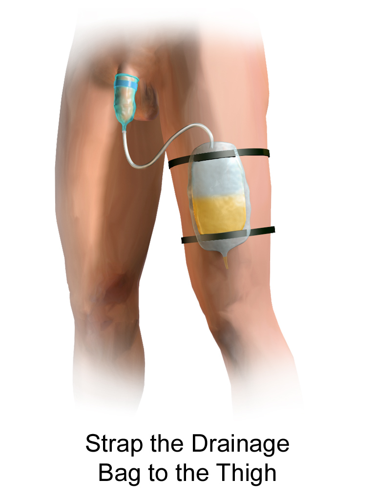 ”Condom Cather Drainage.png” by BruceBlaus is licensed under CC BY-SA 4.0 Illustration showing condom catheter attached to leg bag on male patient