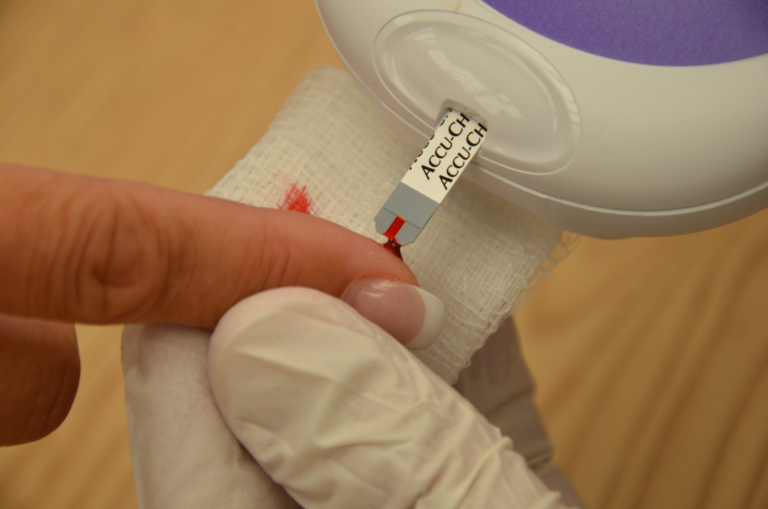 “DSC_1141.jpg” by British Columbia Institute of Technology (BCIT) is licensed under CC BY 4.0. Access for free at https://opentextbc.ca/clinicalskills/chapter/8-2-glucometer-use/. Photo showing the obtainment of a drop of blood on a medical strip