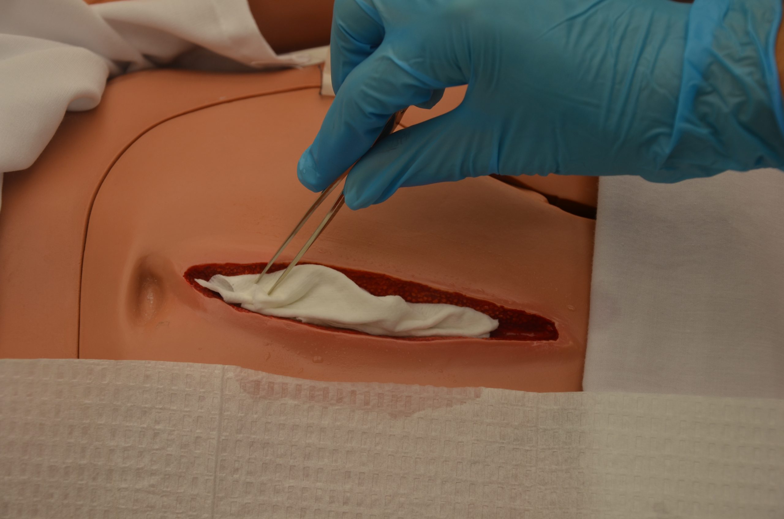 “DSC_1742.jpg” by British Columbia Institute of Technology (BCIT) is licensed under CC BY 4.0. Access for free at https://ecampusontario.pressbooks.pub/clinicalskills/chapter/4-5-complex-dressing-change/ Photo showing packing of simulated wound