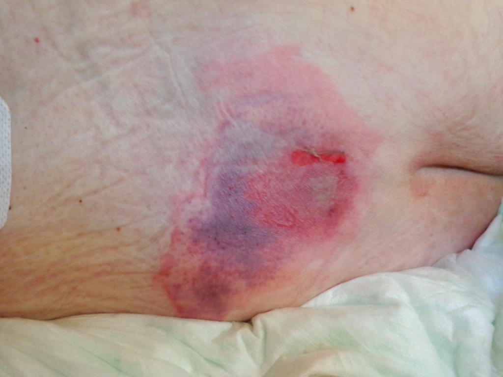 “Decubitus 01.jpg” by AfroBrazilian is licensed under CC BY-SA 3.0 Photo showing closeup of a pressure ulcer on a patient's back