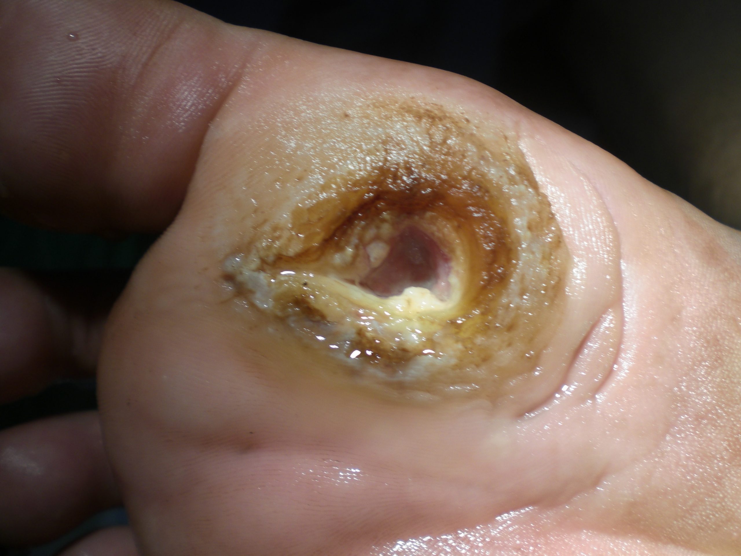 “Diabetic Planta ulcer.jpg” by Dr. Lorimer is licensed under CC BY-SA 4.0 Photo showing closeup of diabetic ulcer on bottom of patient's foot