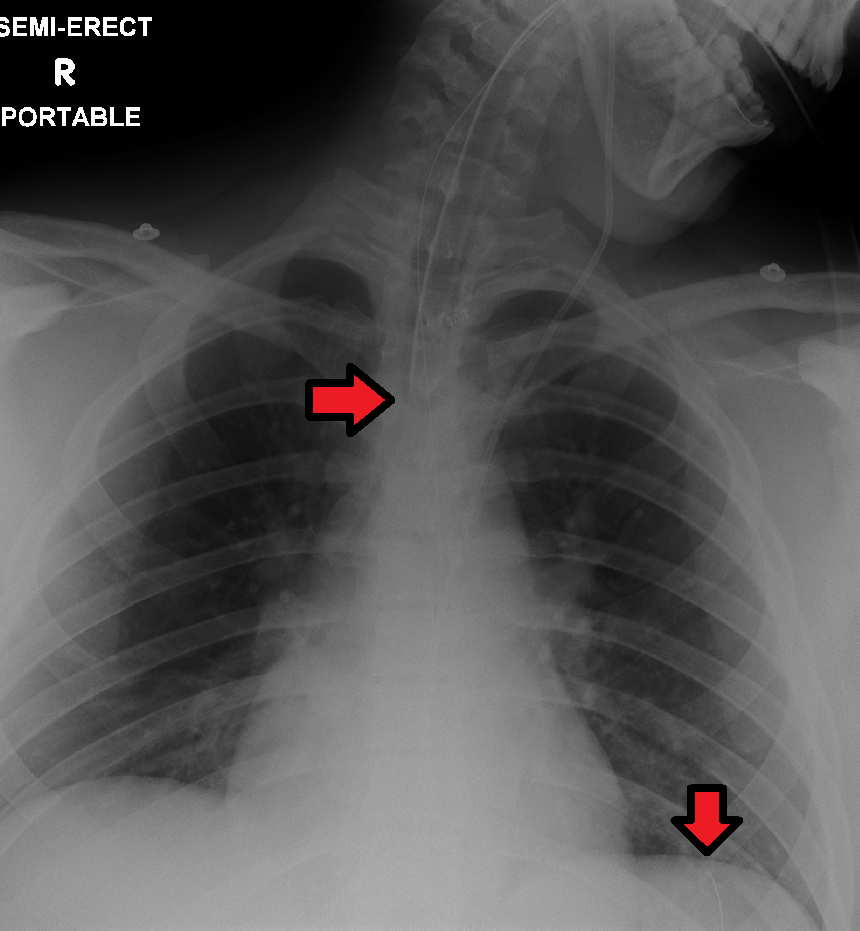 "ETTubeandNGtubeMarked.png" by James Heilman, MD is licensed under CC BY-SA 4.0 X-ray image showing placement verification