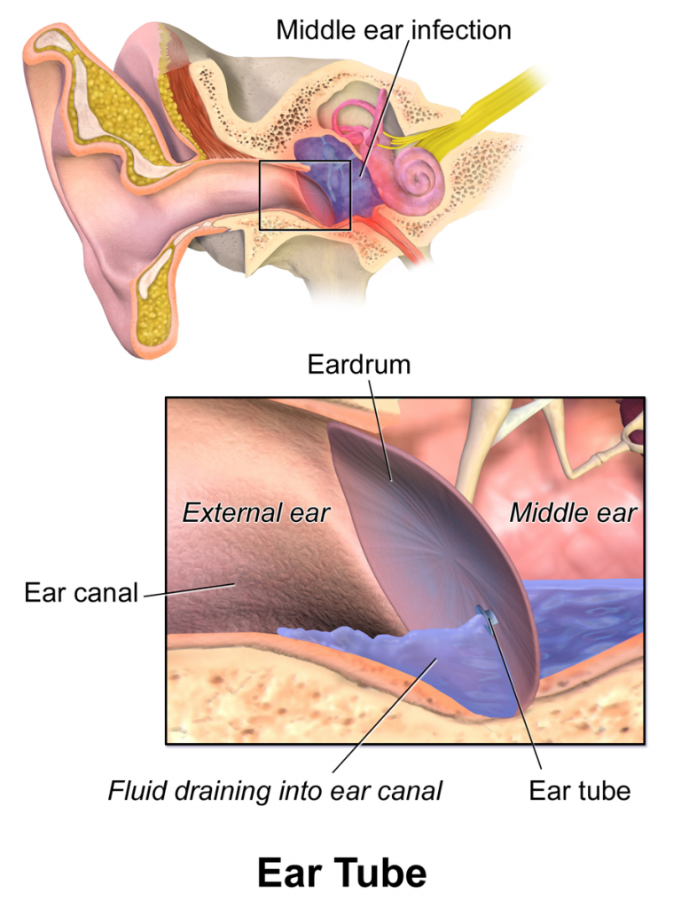 “Ear Tube.png” by BruceBlaus is licensed under CC BY-SA 4.0 Illustration showing middle ear infection and a tympanostomy tube in place to alleviate symptoms.