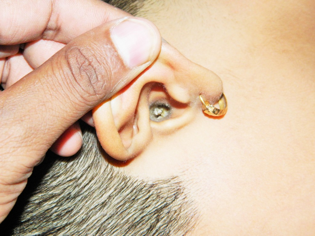 “Ear Wax.JPG” by Anand2202 is licensed under CC BY-SA 4.0 Photo showing an ear canal that is plugged with cerumen