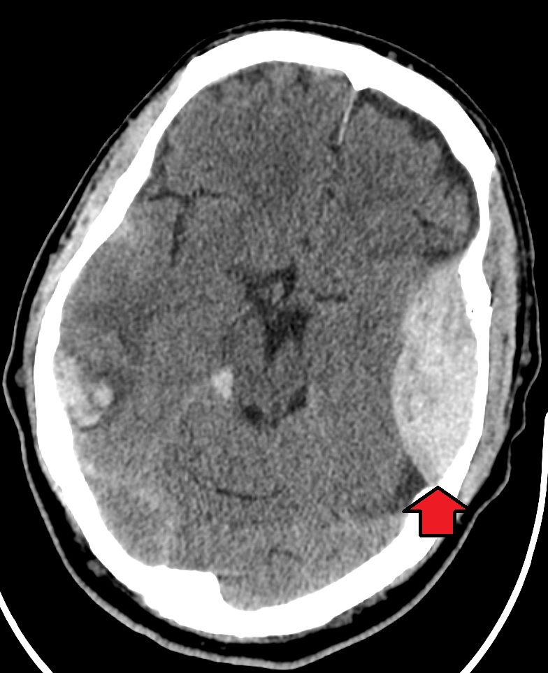 “EpiduralHeatoma.jpg” by James Heilman, MD is licensed under CC BY-SA 4.0 Image showing an epidural hematoma on the person's left with an associated skull fracture.