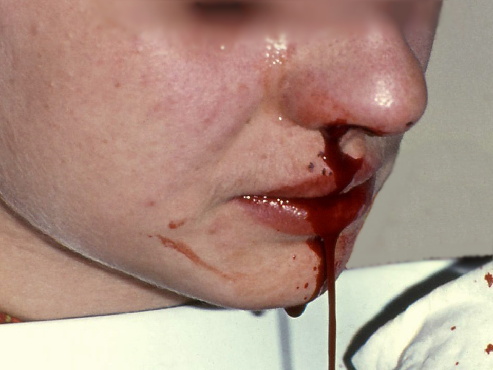 “Epstaxis1.jpg” by Welleschik is licensed under CC BY-SA 3.0 Photo of person experiencing severe nosebleed