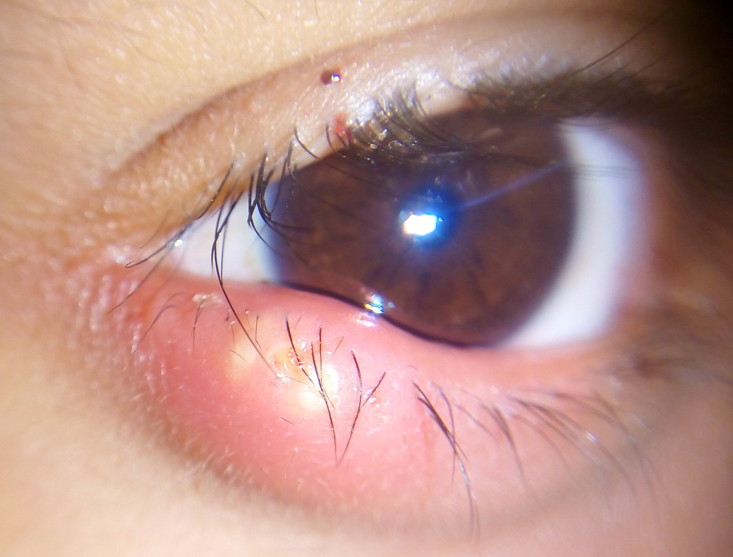 “External hordeolum.jpg” by Inrankabirhossain is licensed under CC BY-SA 4.0 Photo showing closeup of eye with Stye on lower lid