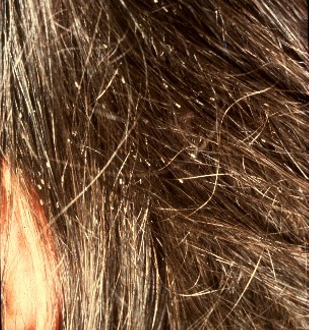 “Fig.5. Louse nites.jpg” by KostaMumcuoglu at English Wikipedia is licensed under CC BY-SA 3.0 Photo showing closeup of person's hair, containing lice nits