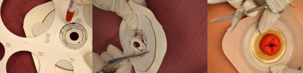 ”Tracing-stoma-size-from-tracing-template-001.jpg”, “DSC_1284-e1442766479432.jpg”, and “Assess-if-flange-is-the-correct-size-for-stoma-001.jpg” by British Columbia Institute of Technology (BCIT) is licensed under CC BY 4.0. Access for free at https://ecampusontario.pressbooks.pub/clinicalskills/chapter/10-6-ostomies/ Photos showing three of the steps in fitting a barrier to a stoma