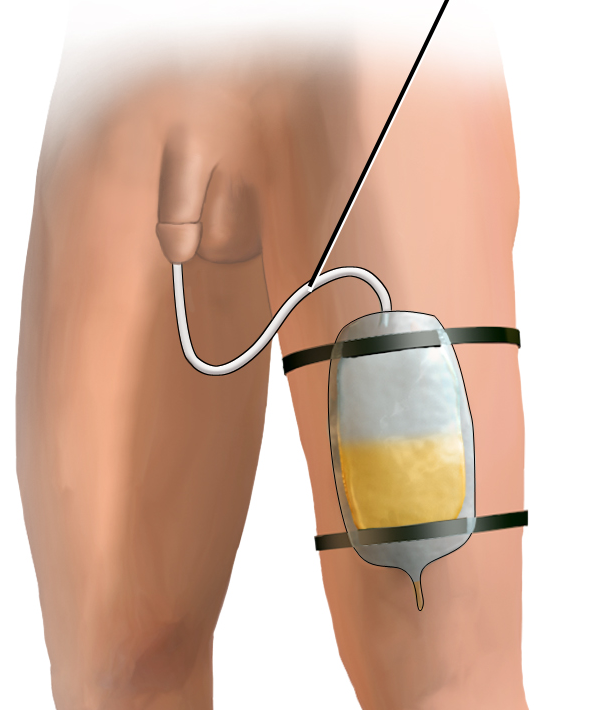 ”Foley Catheter Drainage (cropped).png” by BruceBlaus CC BY-SA 4.0 Illustration showing Indwelling Catheter Attached to Leg Bag on male patient