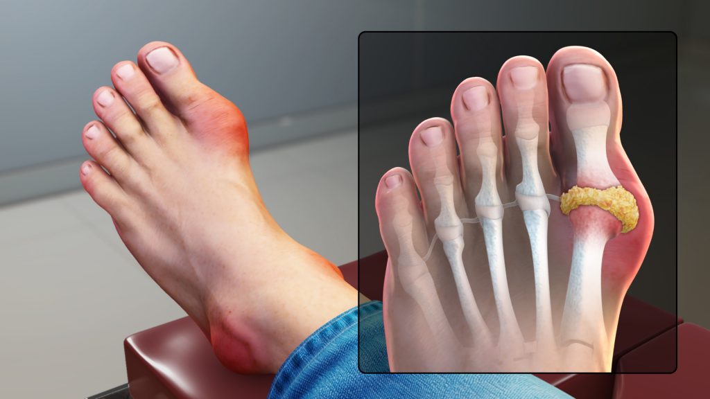 “Gout Signs and Symptoms.jpg” by www.scientificanimations.com/ is licensed under CC BY 4.0 Image showing a foot with gout