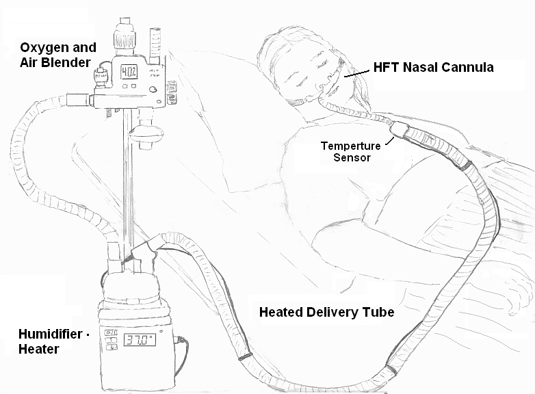 “HFT diagram.png” by Strangecow is in the Public Domain Illustration showing a high flow nasal cannula system, with labels