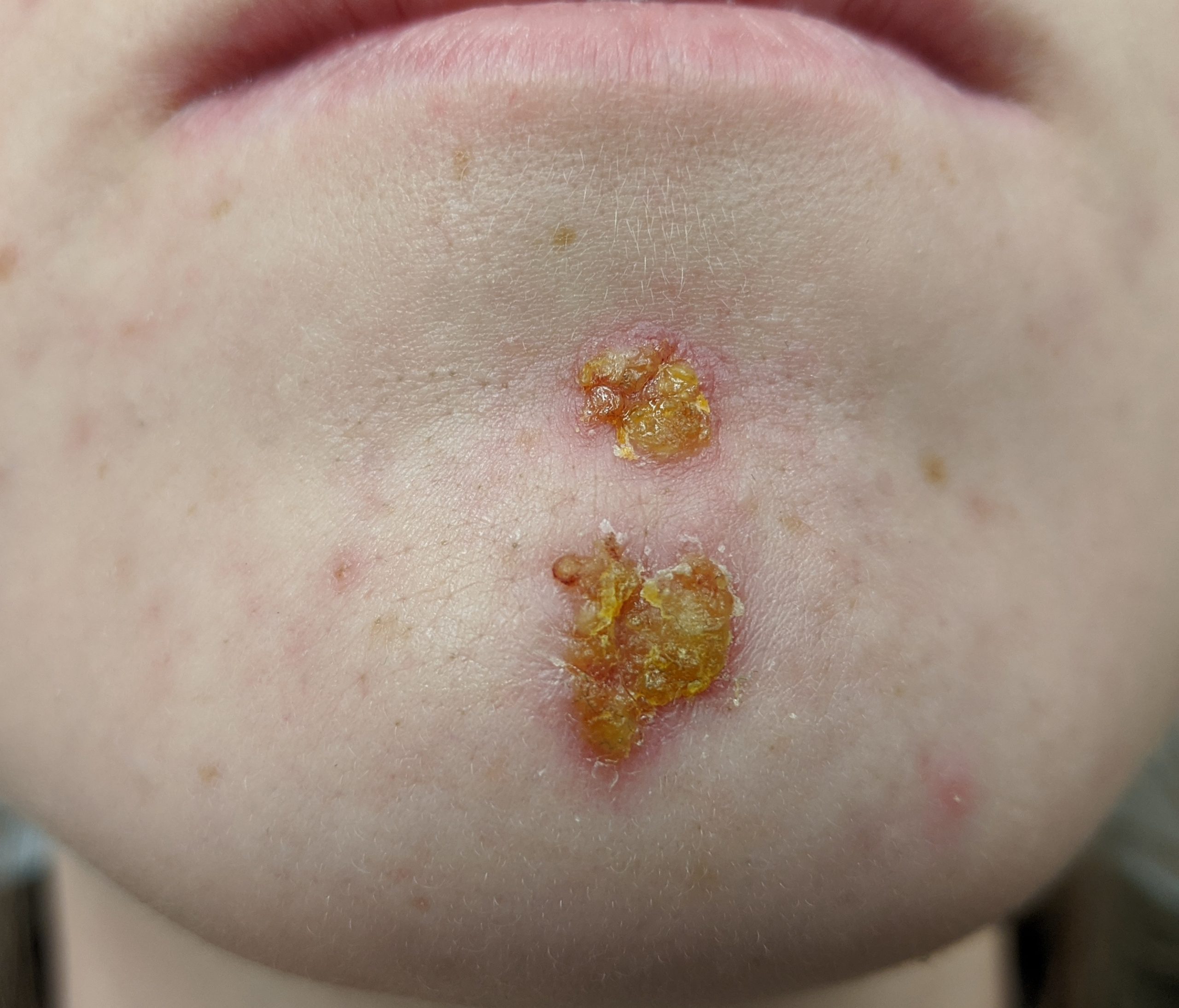 “Impetigo2020.jpg” by James Heilman, MD is licensed under CC BY-SA 4.0 Photo showing closeup of chin area infected with impetigo