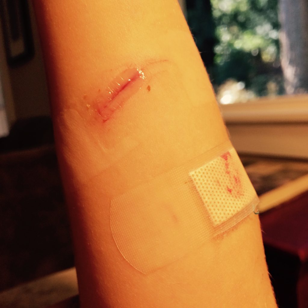 “Incision wound on child's arm, closed with Dermabond.jpg” by ragesoss is licensed under CC BY-SA 3.0 Photo showing Dermanbond on a healing wound