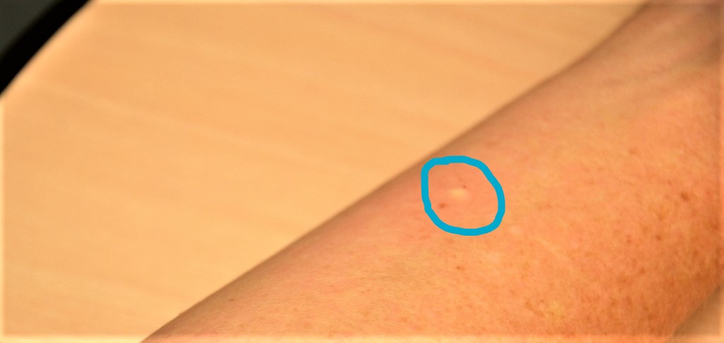 This work is derivative of “Book-pictures-2015-636.jpg" by British Columbia Institute of Technology (BCIT) is licensed under CC BY 4.0. Access for free at https://opentextbc.ca/clinicalskills/chapter/6-7-intradermal-subcutaneous-and-intramuscular-injections/ Photo showing a bleb on an arm, indicated by a circled area