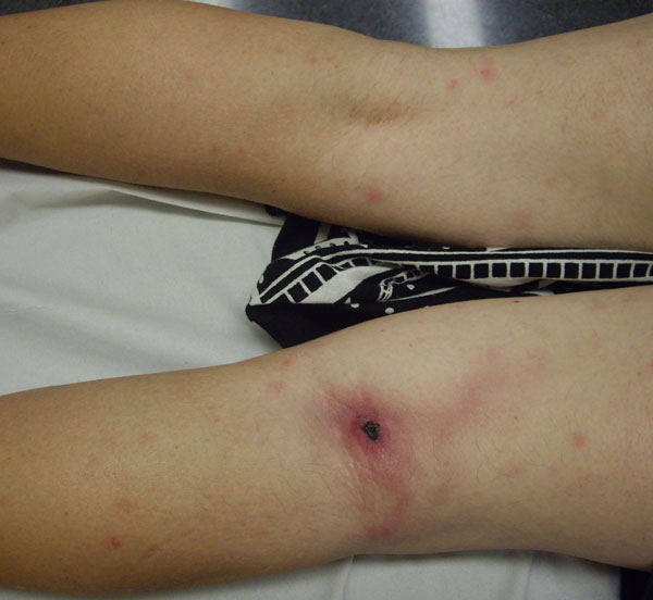 "Inoculation_eschar_Rickettsia_sibirica_mongolitimonae_infection.jpg" by José M. Ramos , Isabel Jado, Sergio Padilla, Mar Masiá, Pedro Anda, and Félix Gutiérrez is licensed under CC0 Photo showing slough on a wound