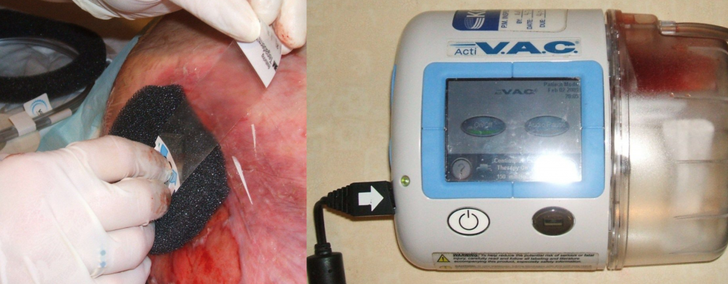 “KCI Wound Vac01.jpg” and "KCI Wound Vac02.jpg" by Noles1984 at English Wikipedia are in the Public Domain Photo showing wound vac and application on patient