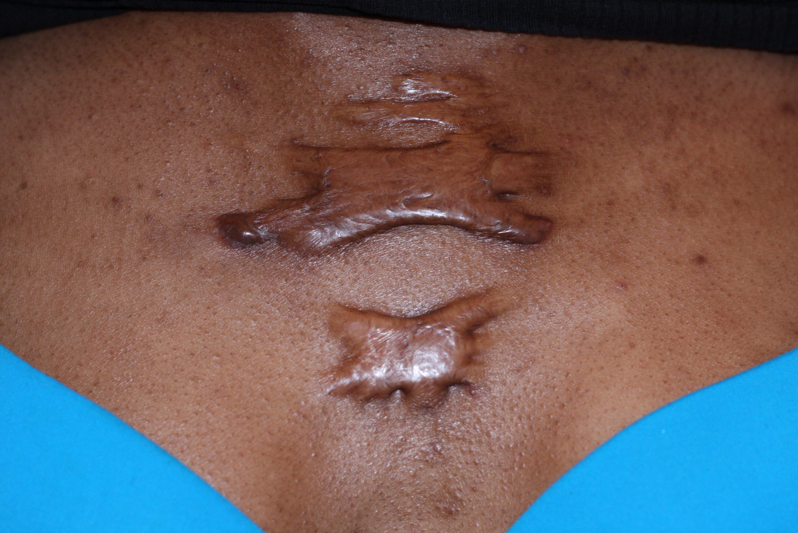 “Keloid-Butterfly, Chest Wall.JPG” by Htirgan is licensed under CC BY-SA 3.0 Photo of a large keloid on a person's chest area