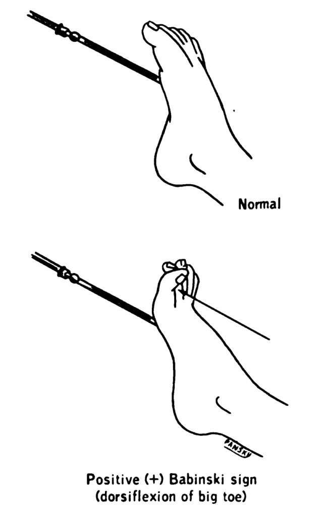 “Lawrence 1960 20.4.png” by House, Earl Lawrence. Pansky, Ben. is in the Public Domain Illustration showing plantar reflex and babinski sign