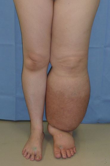 "Lymphedema_limbs.JPG" by Medical doctors is licensed under CC BY-SA 4.0 Photo showing lymphedema in left leg of patient