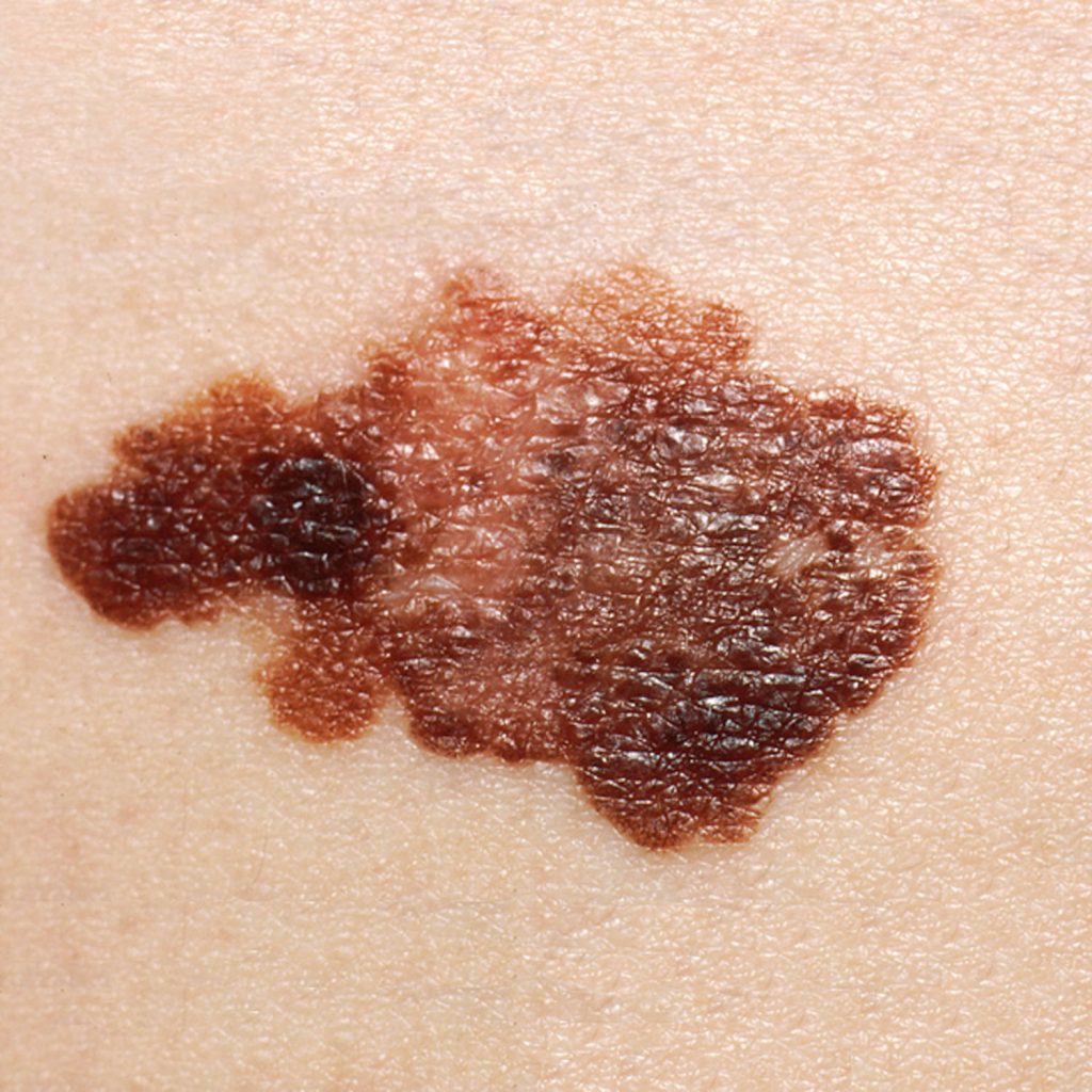 “Melanoma (2).jpg” by unknown photographer, provided by National Cancer Institute is in the Public Domain. Access for free at https://openstax.org/books/anatomy-and-physiology/pages/5-4-diseases-disorders-and-injuries-of-the-integumentary-system. Photo showing closeup of melanoma on skin