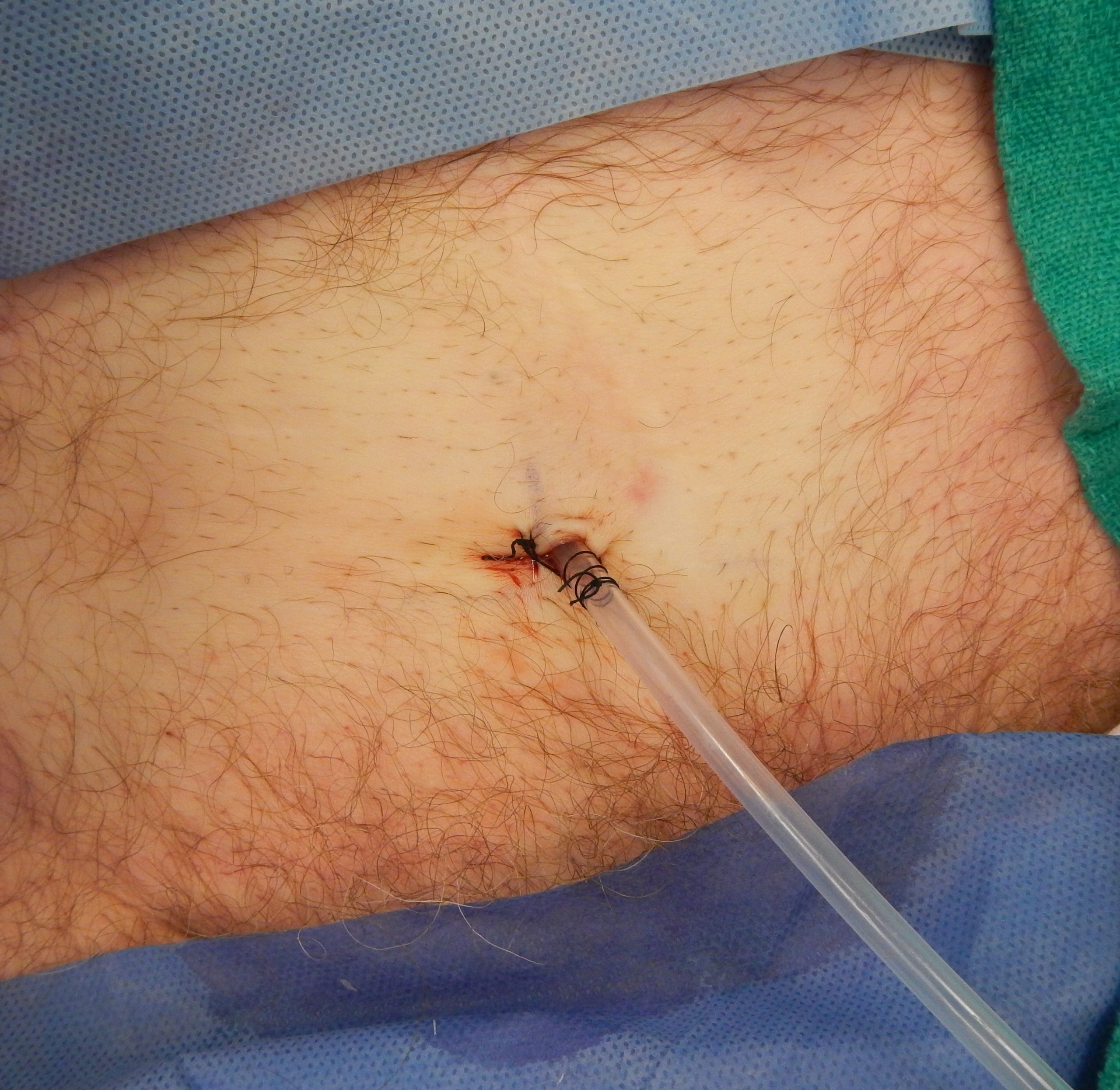 ”NewlyPlaceSubprapubic.jpg” by James Heilman, MD is licensed under CC BY-SA 4.0 Photo showing a newly placed suprapubic catheter