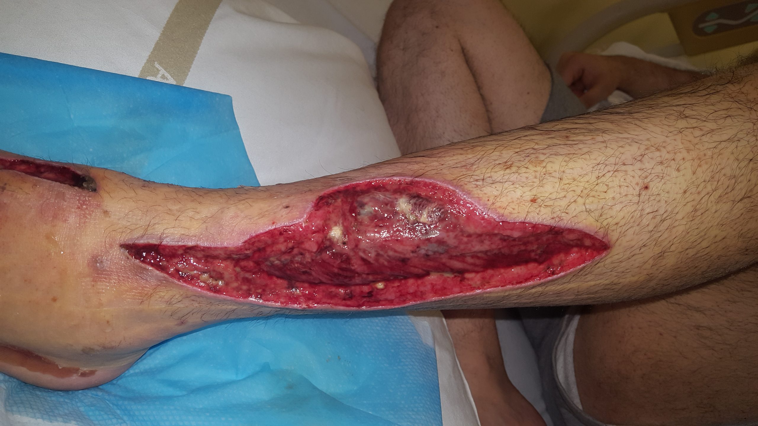 “Open wound after debridement of NF.jpg” by Morphx1982 is licensed under CC BY-SA 4.0 Photo showing wound debridement on lower leg