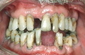 “Periodontal Disease.png” by Warren Schnider is licensed under CC BY-SA 4.0 Photo showing periodontal disease progress in person's mouth