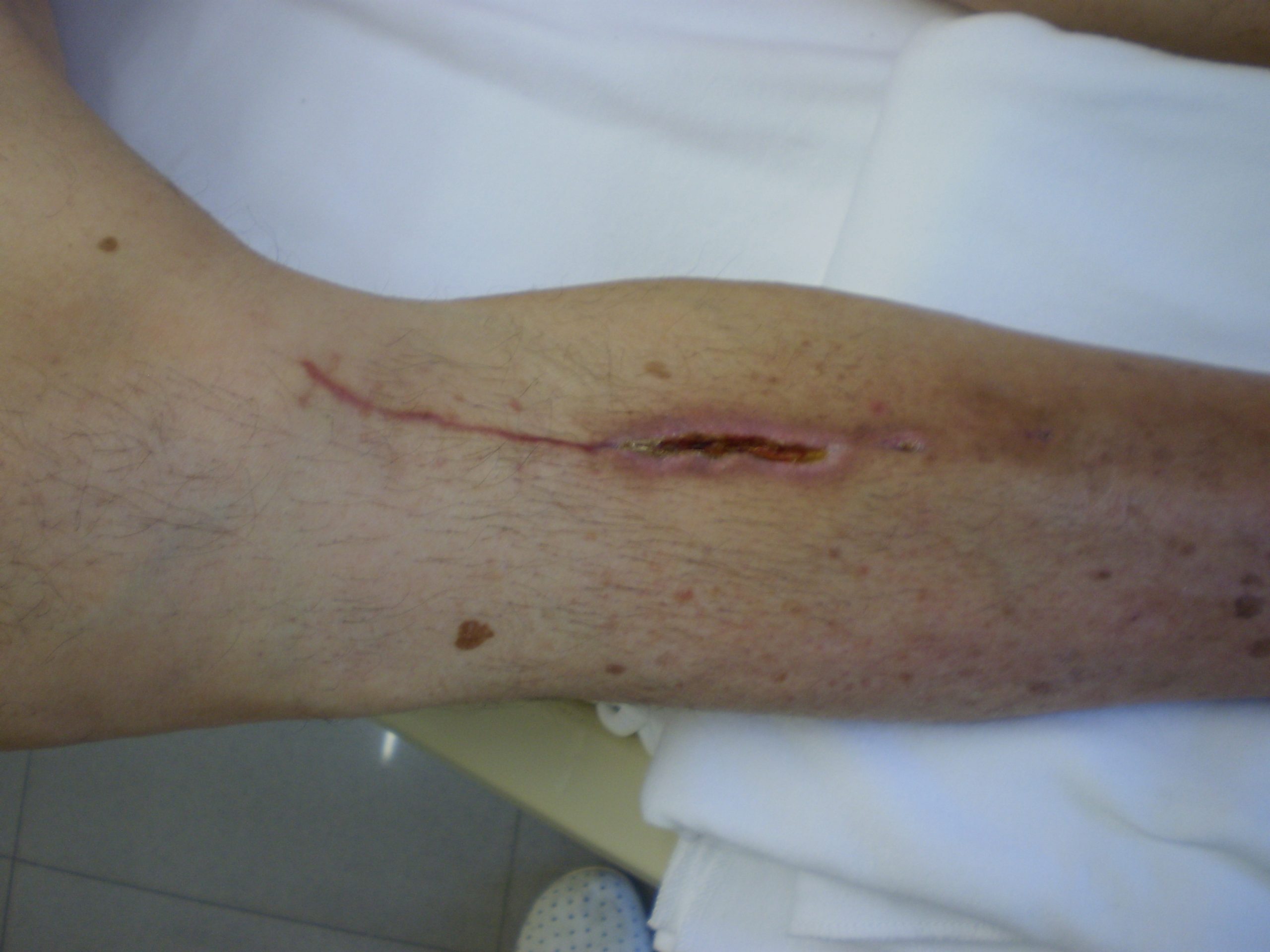 “Post operative wound.JPG” by Intermedichbo is licensed under CC BY-SA 3.0 Photo showing closeup of post operational periwound