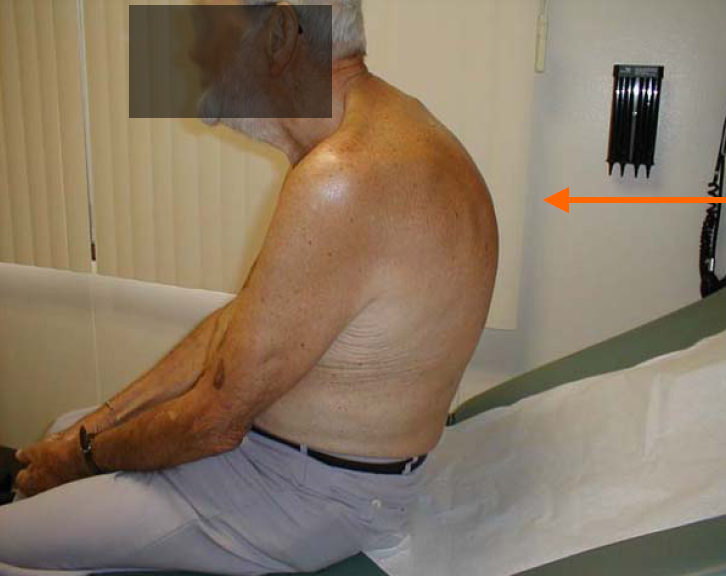 “Posturalkyphosis” by Lab Science Career licensed under CC BY-NC-SA 2.0 Photo of man with posturalkyphosis