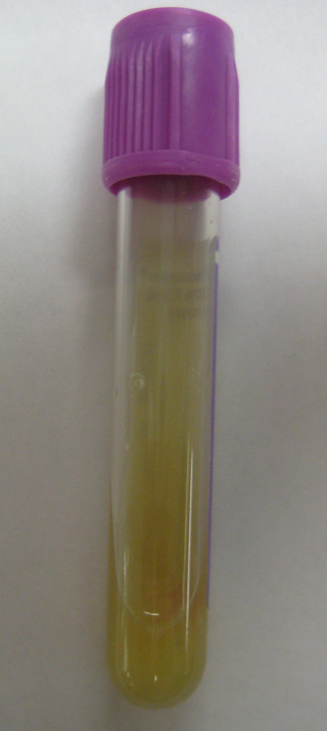 “Purulant knee aspirate.JPG” by James Heilman, MD is licensed under CC BY 3.0 Photo showing vial of purulent drainage