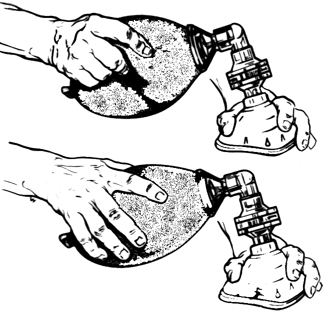 “Resuscitator 3 - Operation (PSF).png” by Pearson Scott Foresman is in the Public Domain Illustration showing operation of a bag valve mask