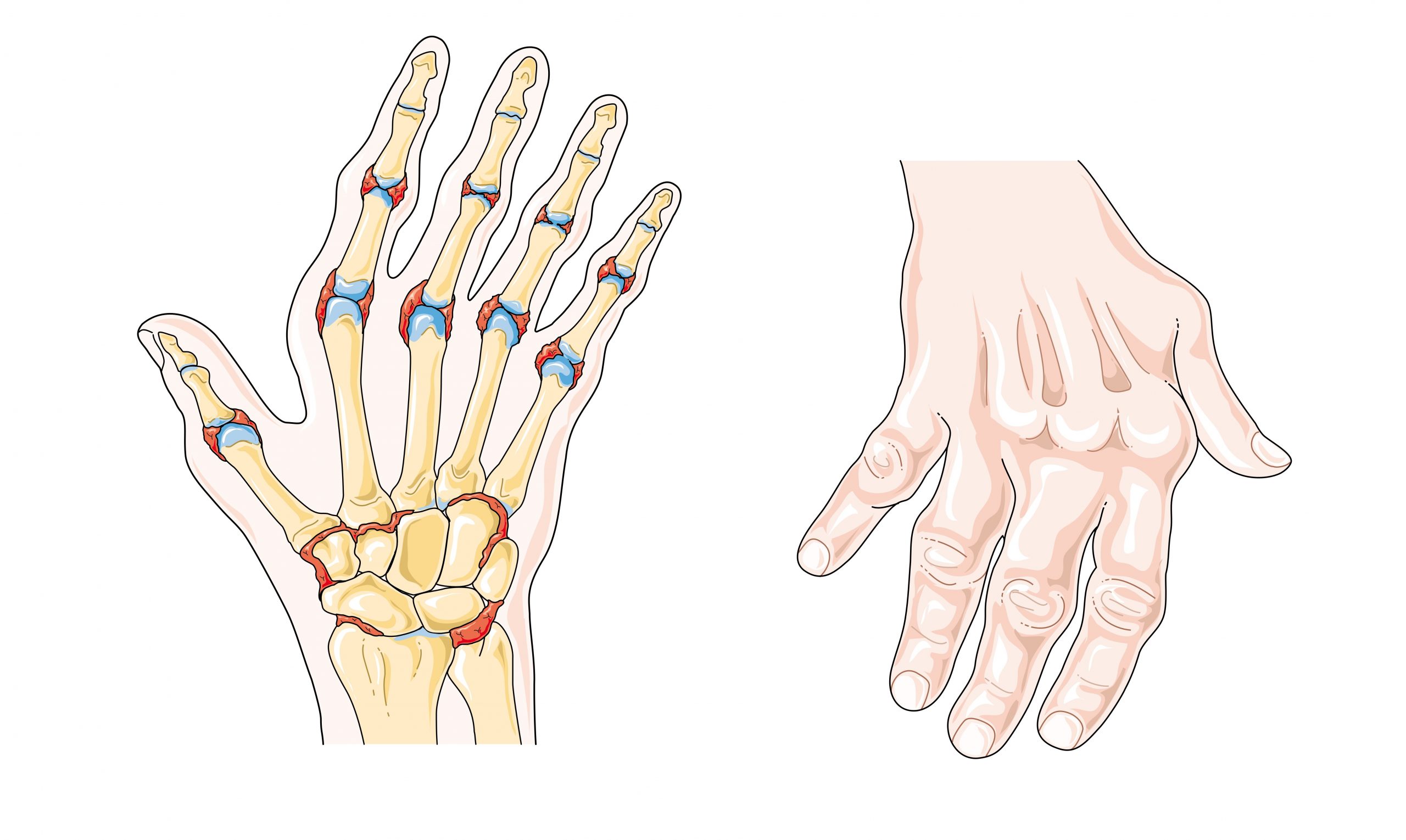 “Rheumatoid arthritis -- Smart- Servier (cropped).jpg” by Laboratoires Servier is licensed under CC BY-SA 3.0 Illustration showing hands with rheumatoid arthritis