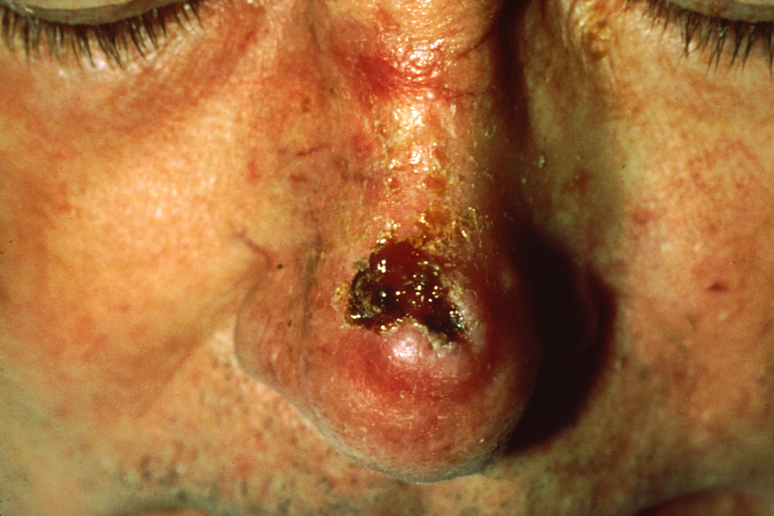 “Squamous cell carcinoma (3).jpg” by unknown photographer, provided by National Cancer Institute is licensed under CC0. Access for free at https://openstax.org/books/anatomy-and-physiology/pages/5-4-diseases-disorders-and-injuries-of-the-integumentary-system. Photo showing damage from squamous cell carcinoma on a person's nose