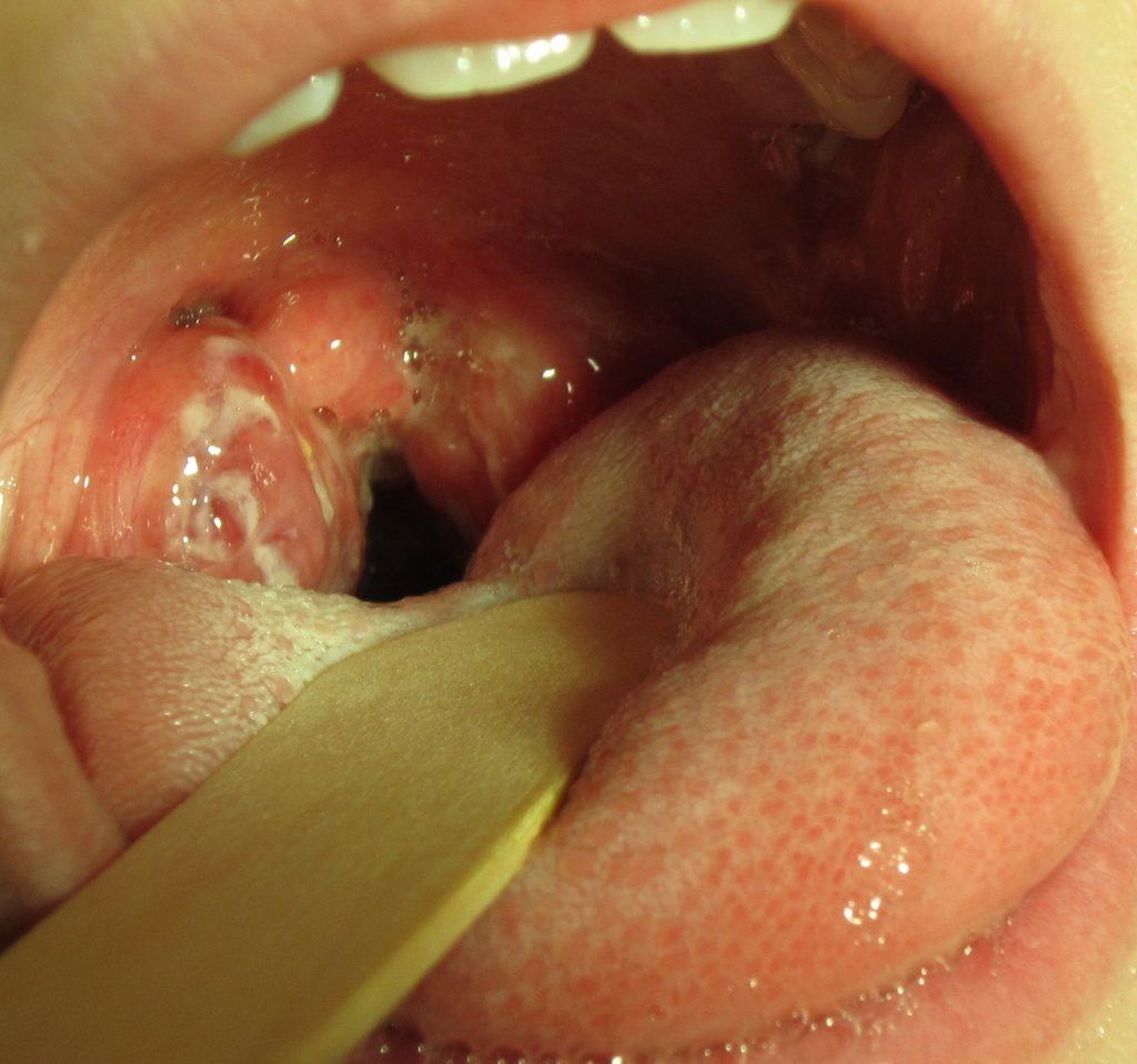 “Strep throat2010.JPG” by James Heilman, MD is licensed under CC BY-SA 3.0 Photo showing closeup of throat infected with streptococcus