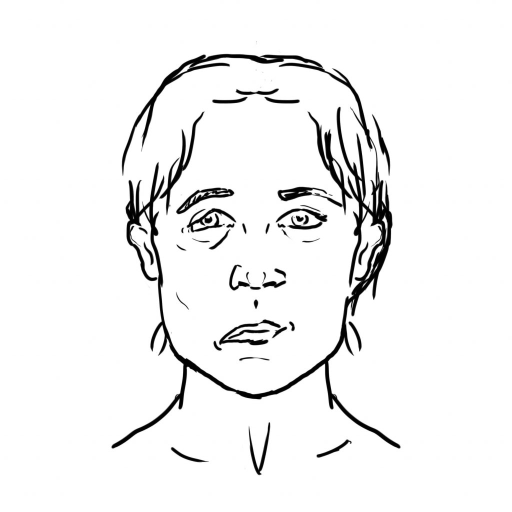 “Stroke-facial-droop.jpg” by Another-anon-artist-234 is licensed under CC0 1.0 Illustration showing a person with one side of their face drooping