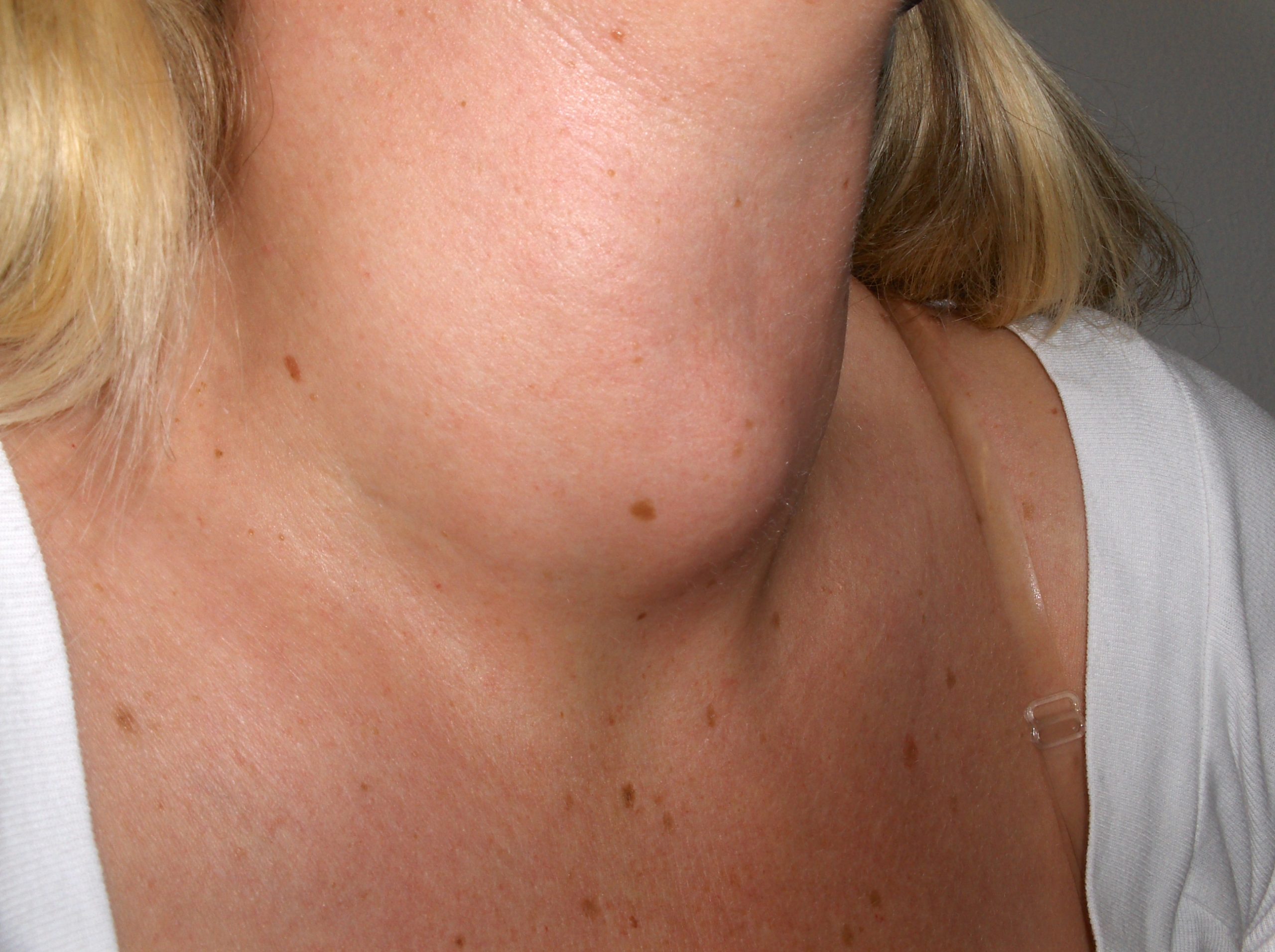 “Struma 00a.jpg” by Drahreg01 is licensed under CC BY-SA 3.0 Photo showing a goiter on a person's neck