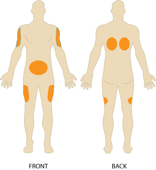 “Subcutaneous-injection-sites-274x300.png”by British Columbia Institute of Technology (BCIT) is licensed under CC BY 4.0. Access for free at https://opentextbc.ca/clinicalskills/chapter/6-7-intradermal-subcutaneous-and-intramuscular-injections/ Illustration showing subcutaneous injection sites
