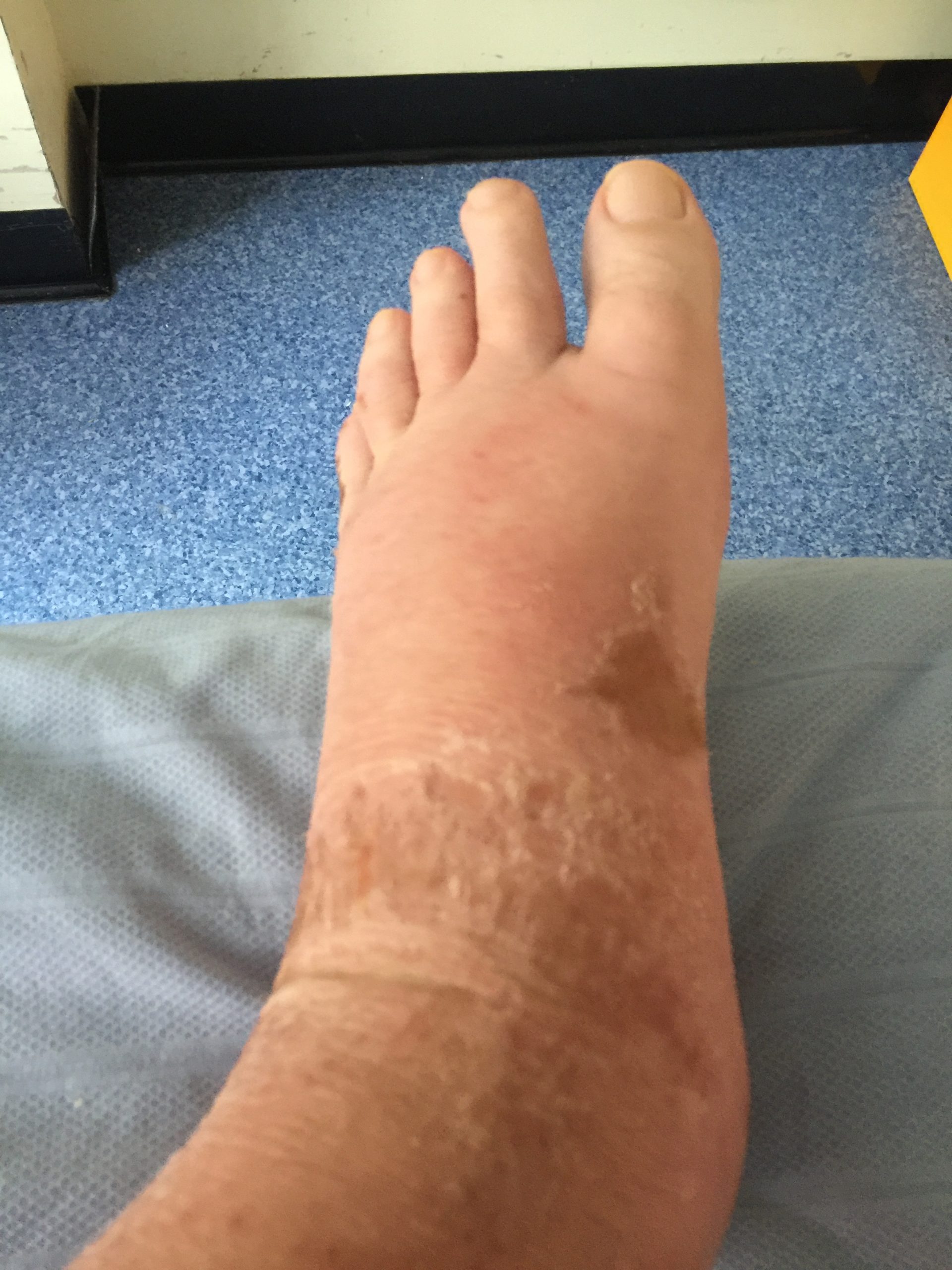 “Swollen feet at Harefield Hospital edema.jpg” by Ryaninuk is licensed under CC BY-SA 4.0 Photo of swollen foot
